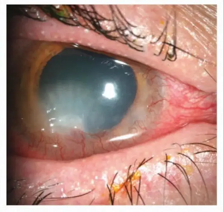 美麗的誤會：當“玫瑰”不是花，而是玫瑰痤瘡